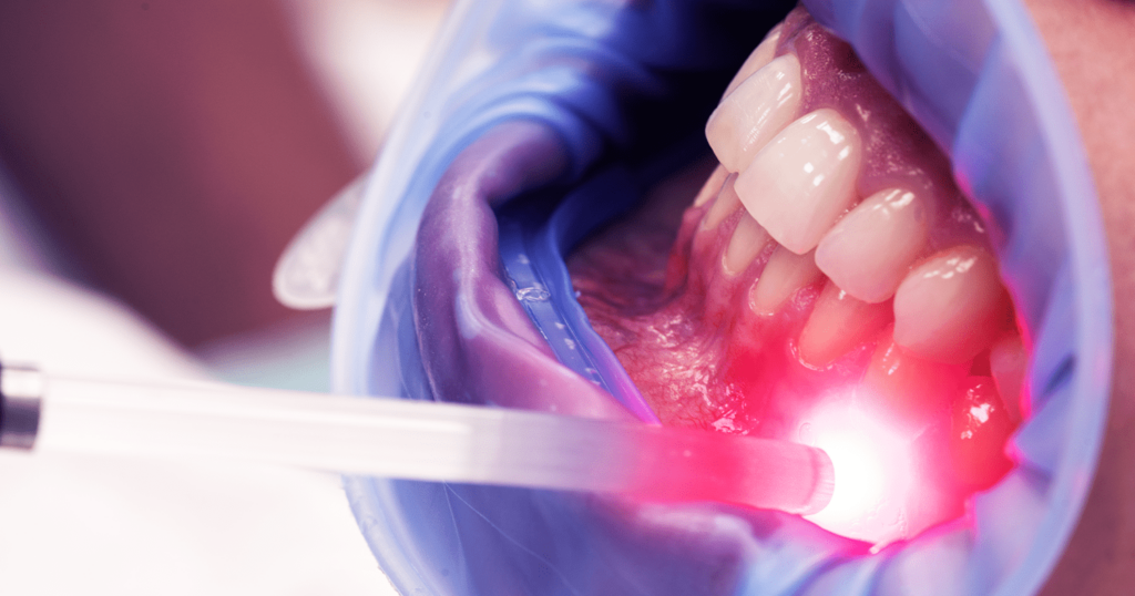 Aplicações do Laser de Baixa Potência na odontologica