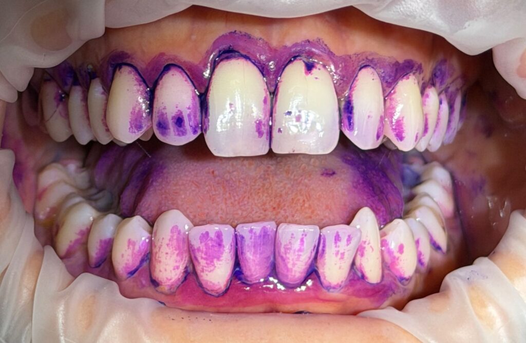 Sorriso em destaque com dentes com corante evidenciando os locais com placa bacteriana